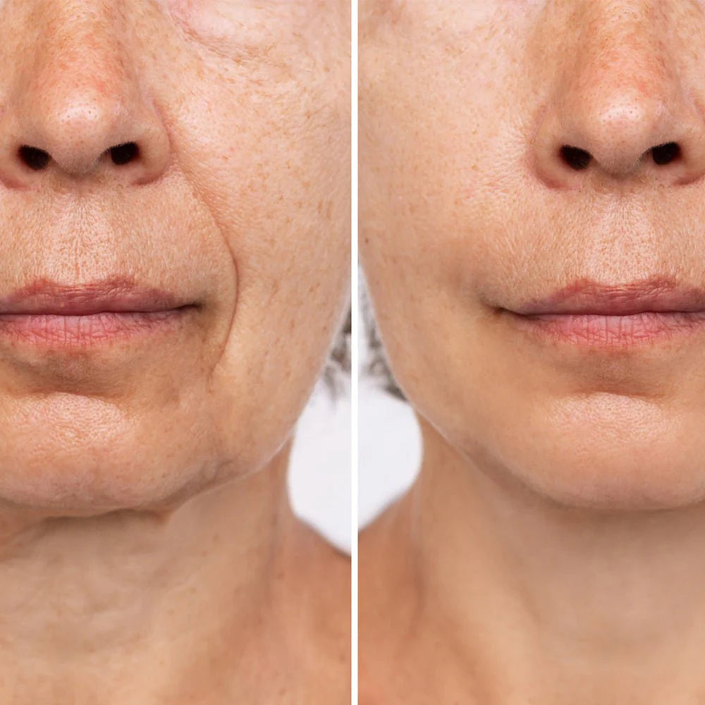 LIROMA® LED therapeutic red light and near-infrared face, neck and décolleté mask